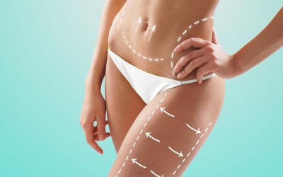 Tummy Tuck Procedure Solihull