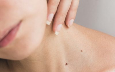 Skin cancer treatment Birmingham